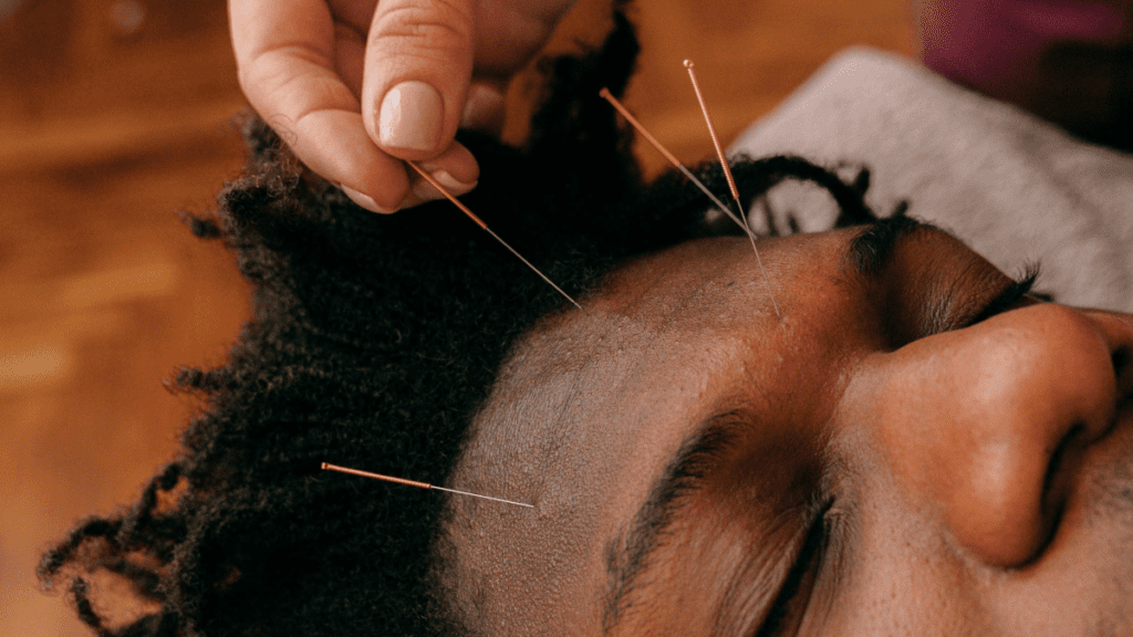 Agopuntura viso_1 | Treatwell